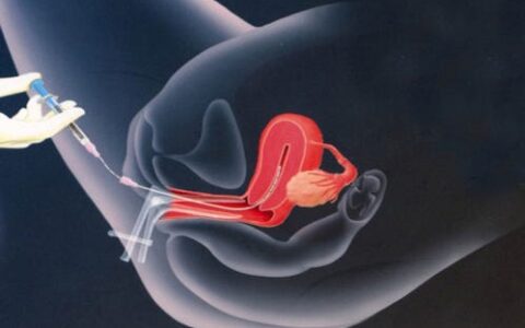 Role of Uttarabasti in Various Infertility Factors and Its Outcome