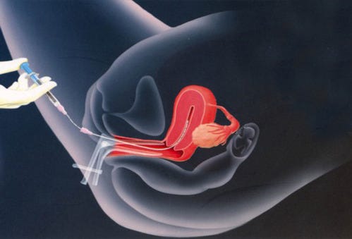 Role of Uttarabasti in Various Infertility Factors and Its Outcome